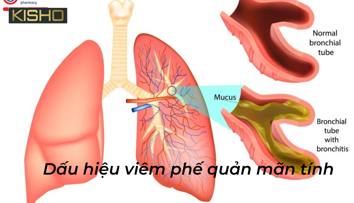Dấu hiệu viêm phế quản mãn tính