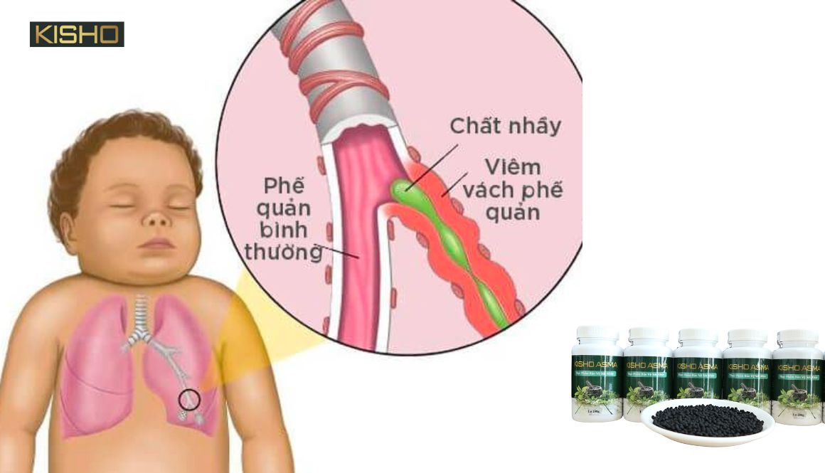 Cách chữa hen suyễn bằng đông y hiệu quả
